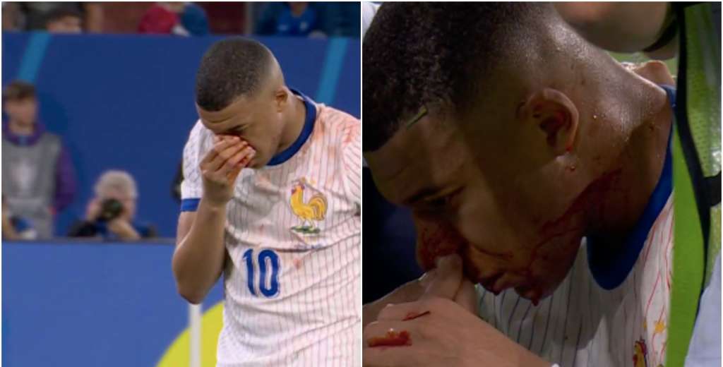 Kylian Mbappé se fue bañado en sangre: la lesión más dura de su carrera...